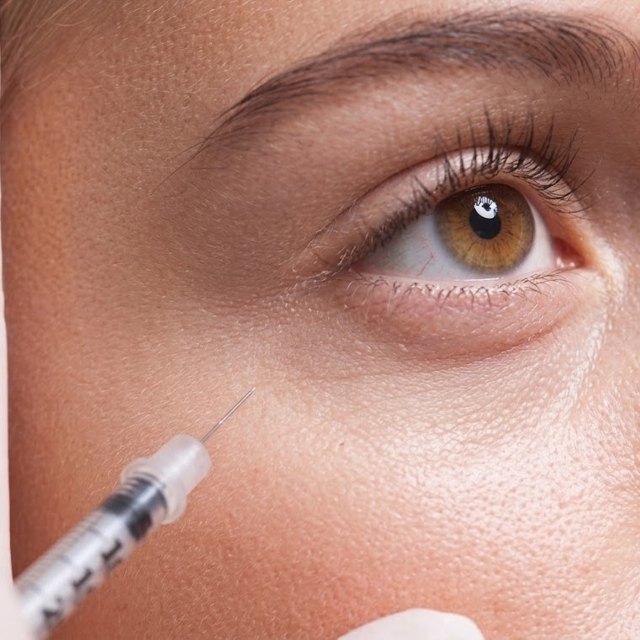 Tratamiento de ojeras